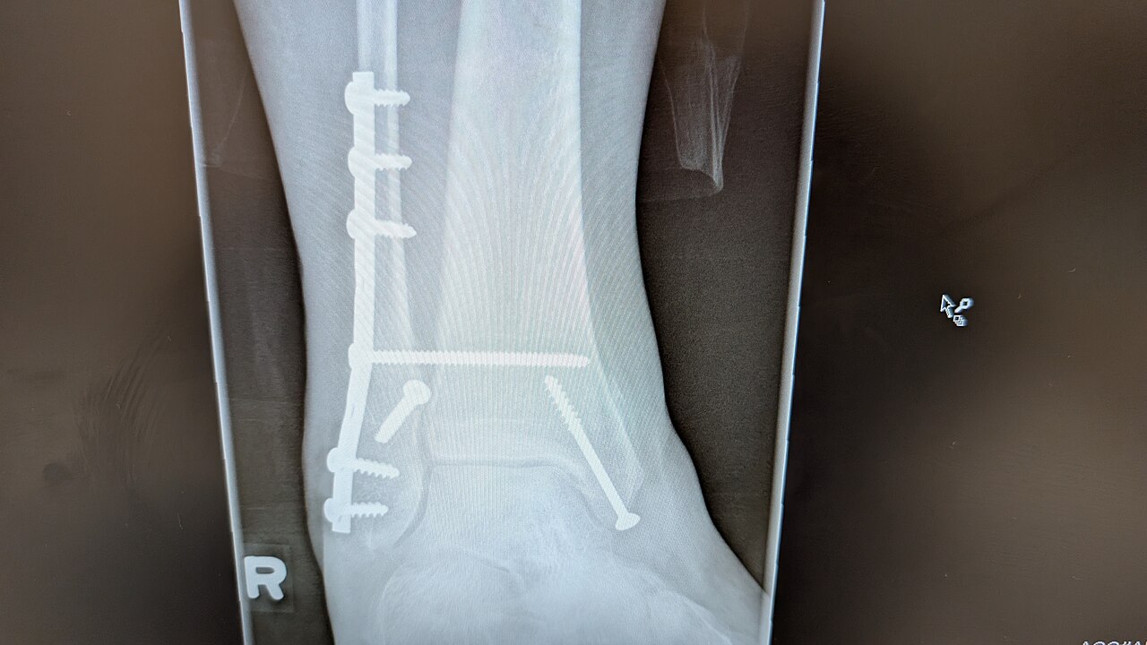Open fracture