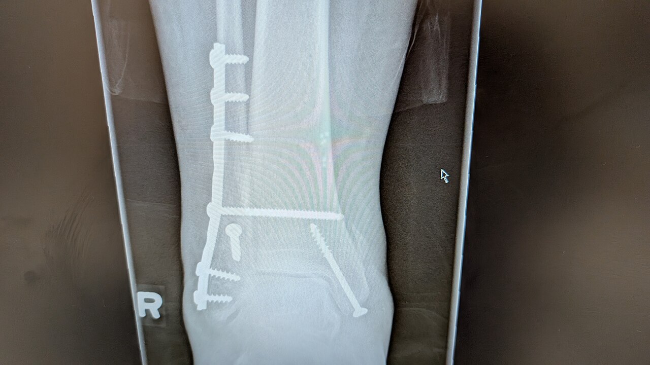 Open fracture