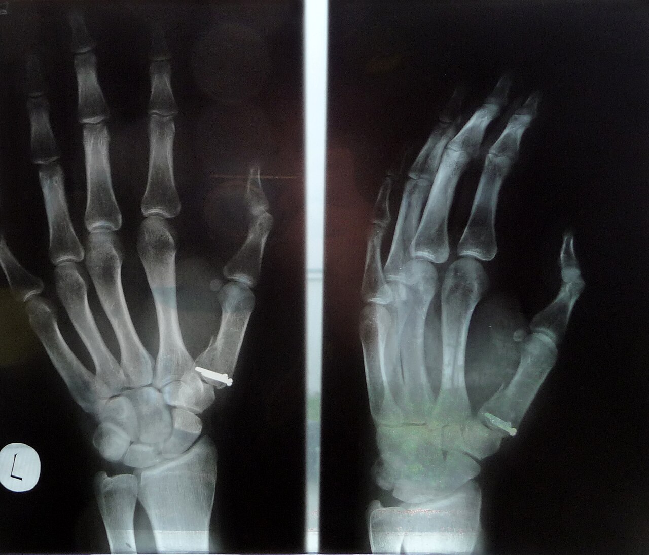 Open fracture