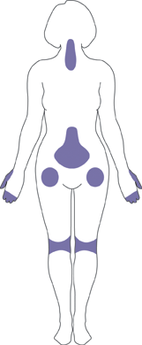 Osteoarthritis