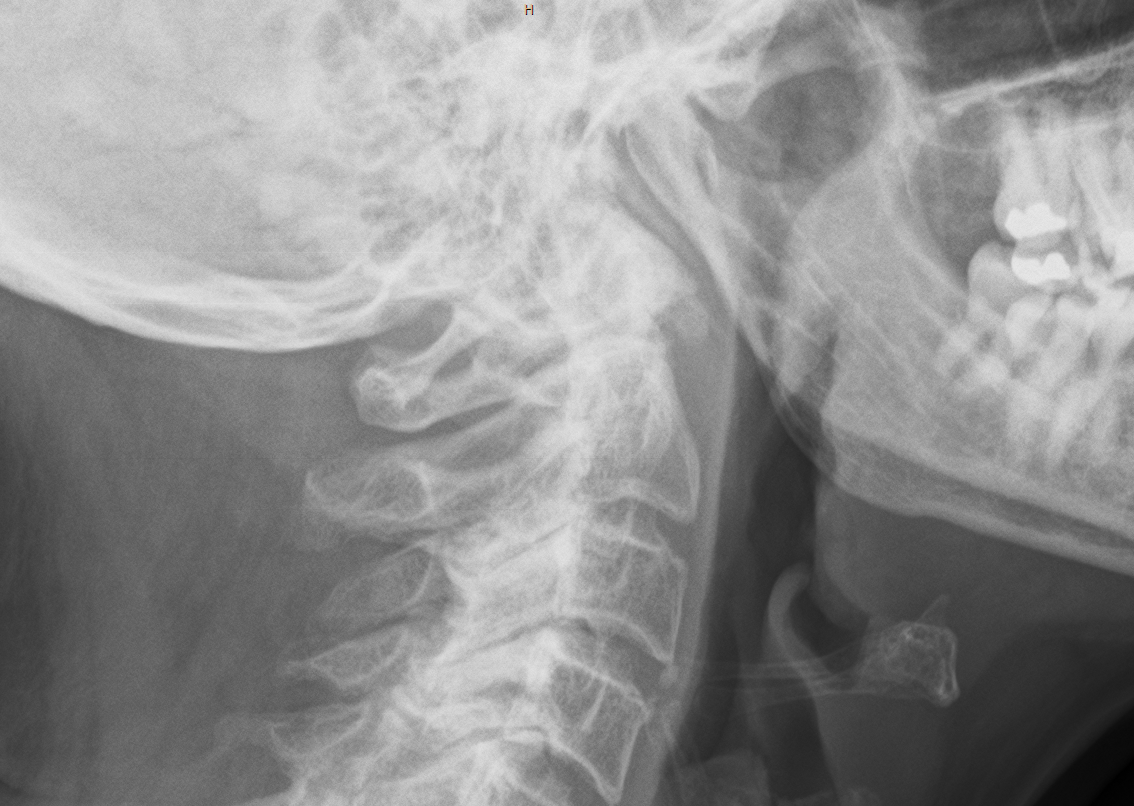 Osteoarthritis