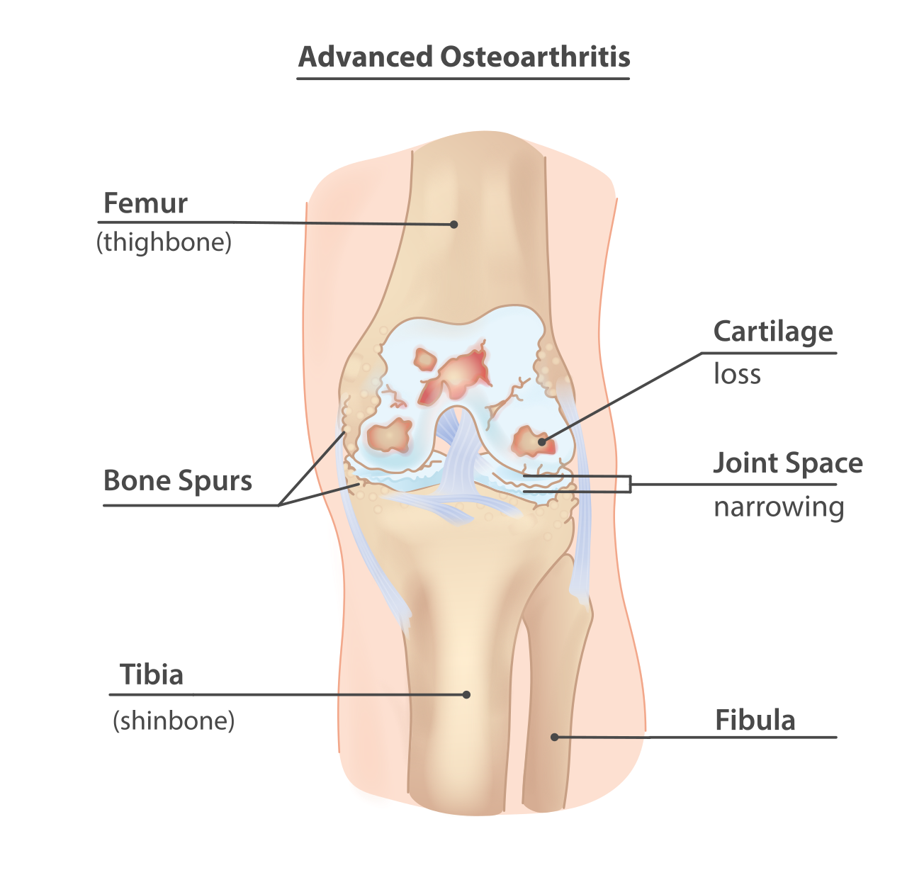 Osteoarthritis