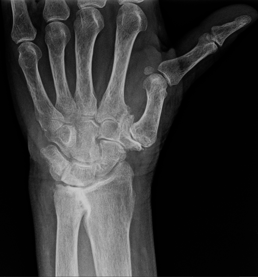 Osteoarthritis