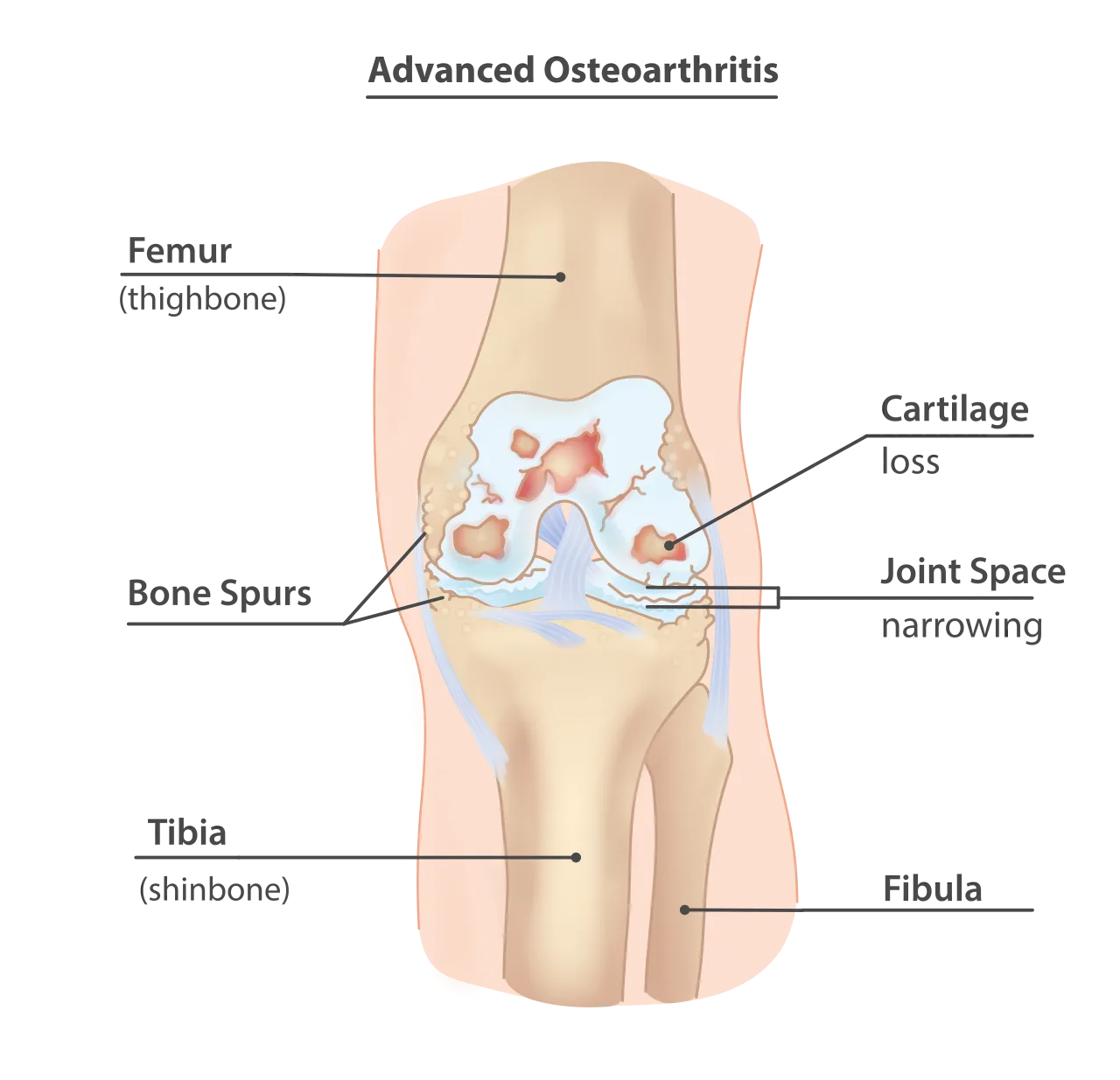 Osteoarthritis