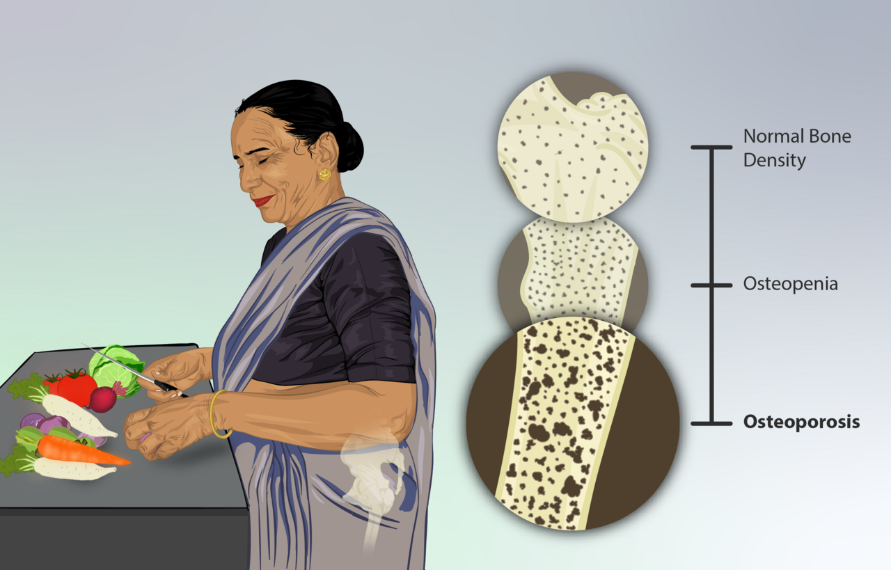 Osteoporosis