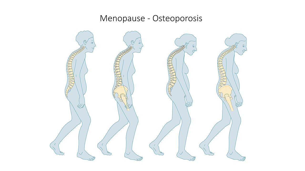 Osteoporosis