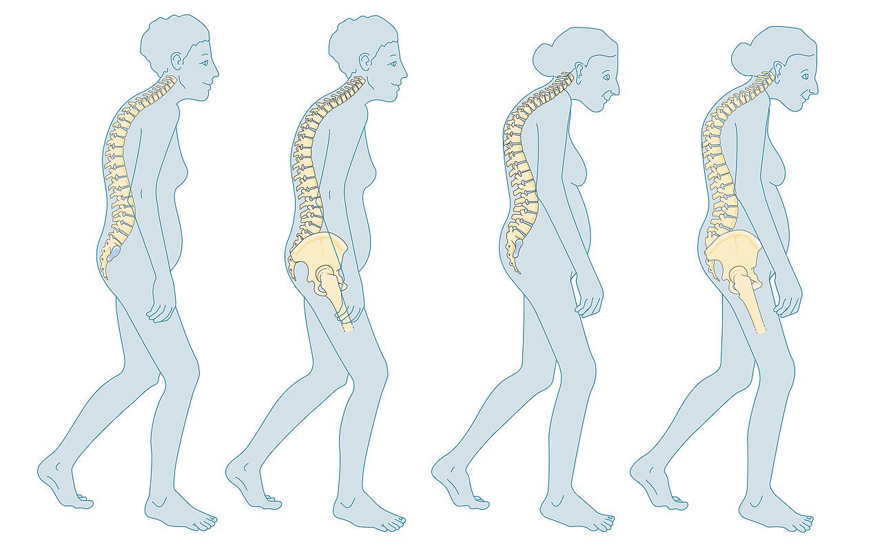 Osteoporosis