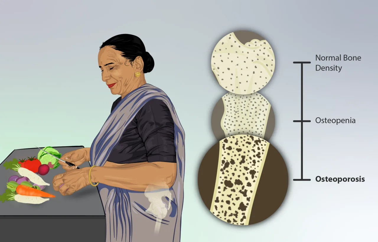 Osteoporosis