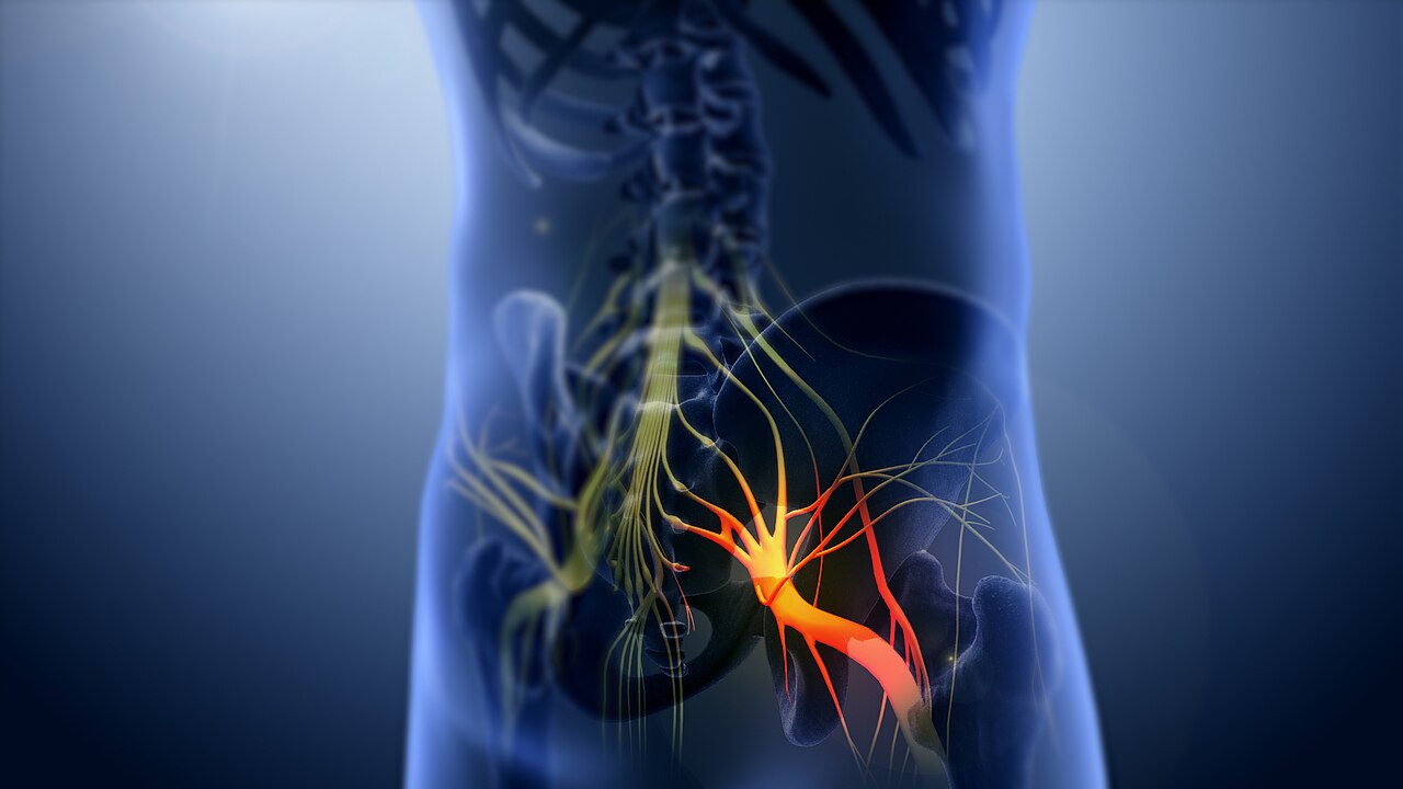 Sciatica