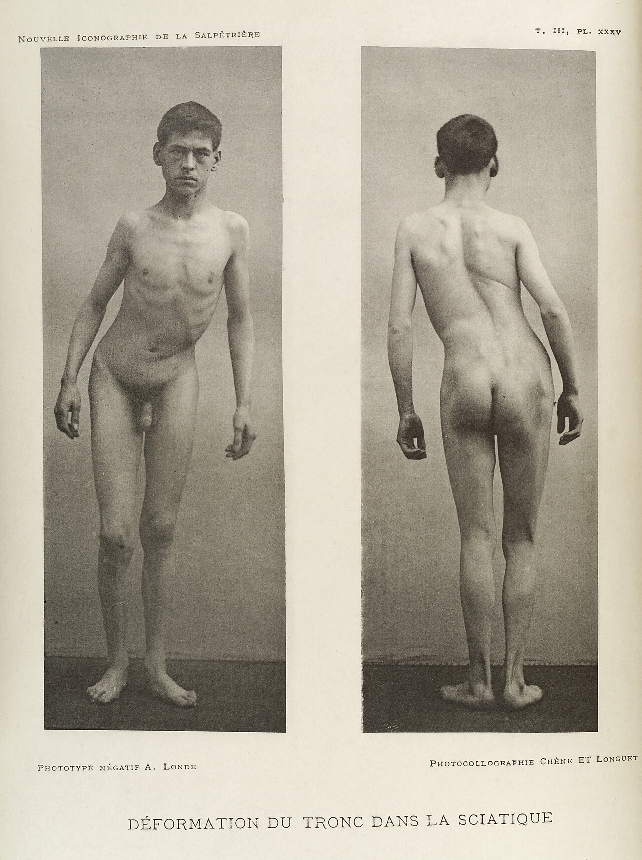 Sciatica
