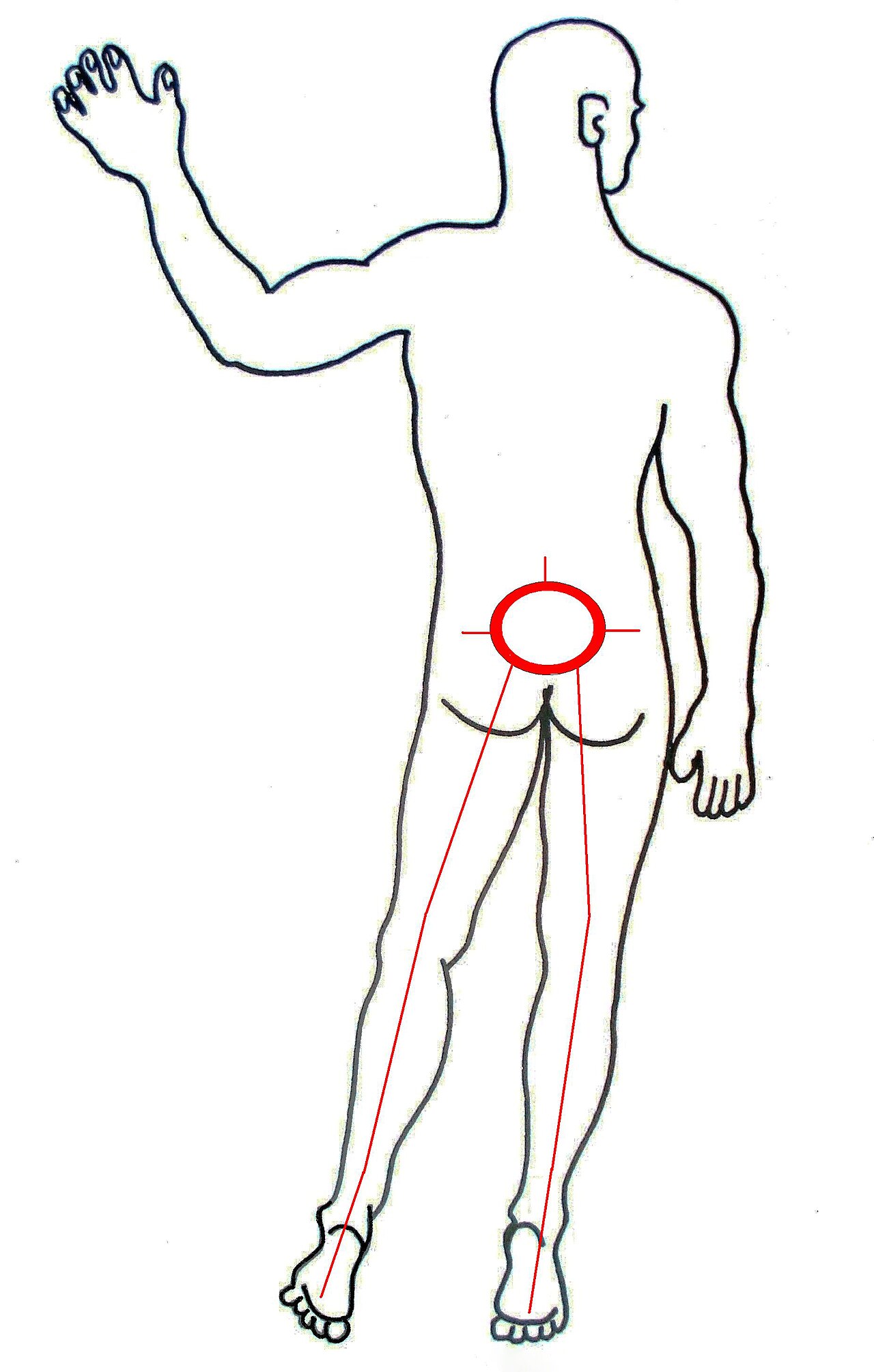 Sciatica