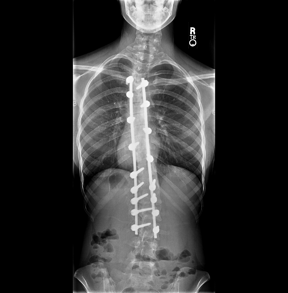 Scoliosis