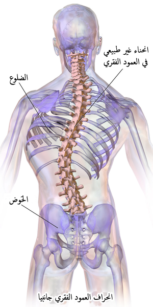 Scoliosis