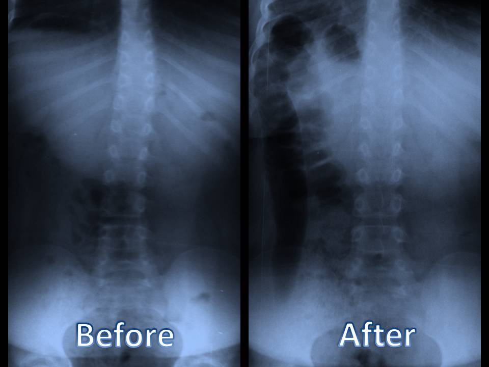 Scoliosis