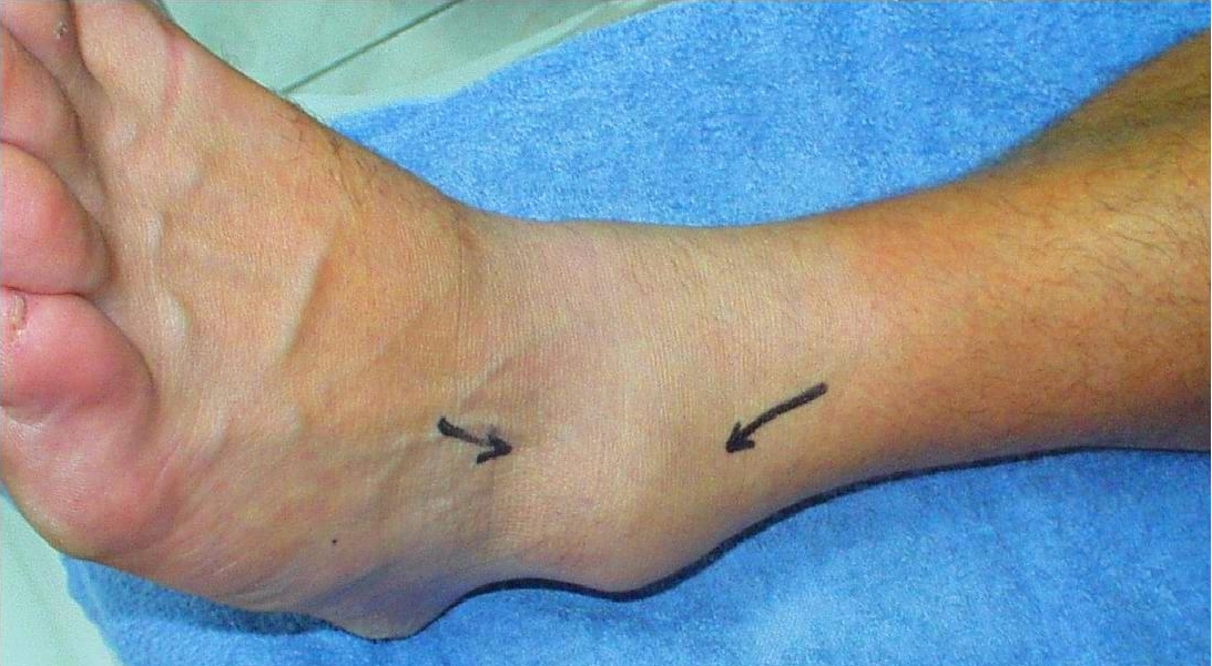 Sprain