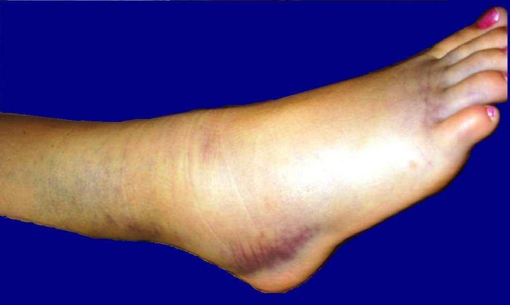 Sprain