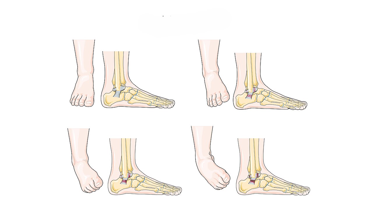 Sprain