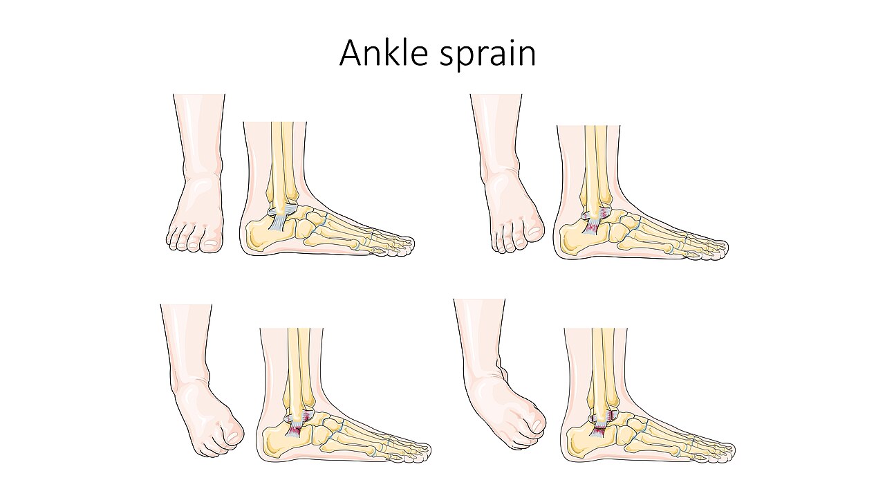 Sprain